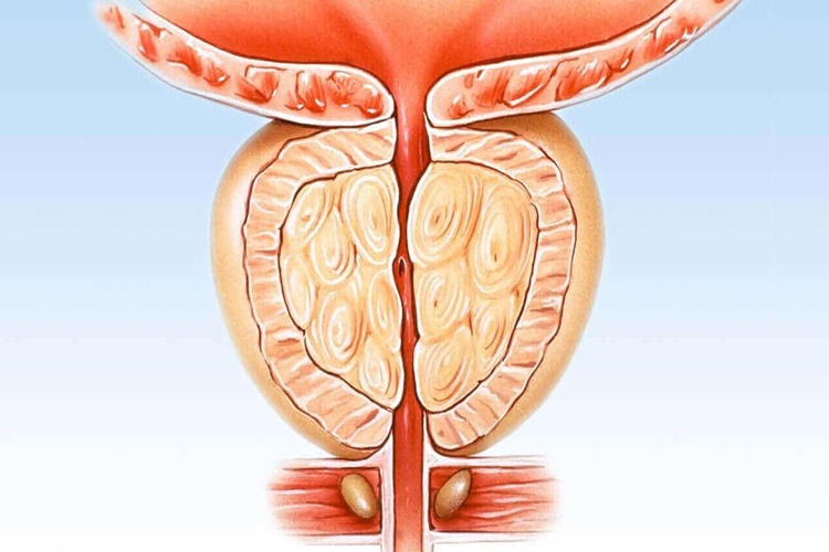 Prostat Kanserinin Tedavisi Var Mı?