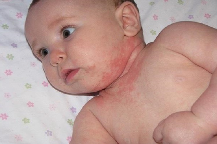 Protein Alerjisi İçin Hamur İşleri Zararlı mı?