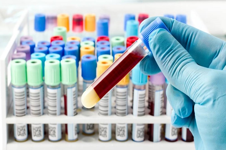 Psa Testi Aç Karnına Mı Yapılır?