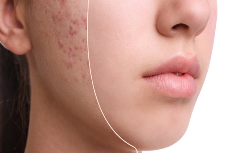 Roaccutane Devlet Karşılıyor Mu?