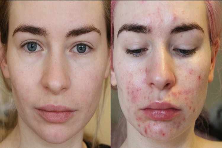 Roaccutane Etkisi Ne Zaman Geçer?