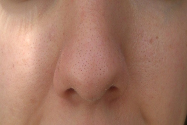 Roaccutane Güneş Lekesi Yapar Mı?