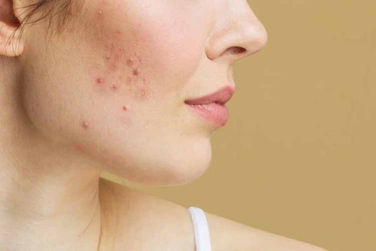 Roaccutane Kilo Aldırır Mı?
