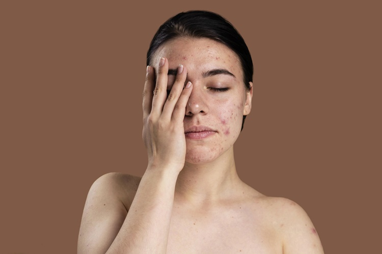 Roaccutane Polisliğe Engel Mi?