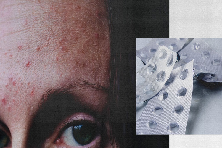  Roaccutane Sakal Çıkarır Mı?