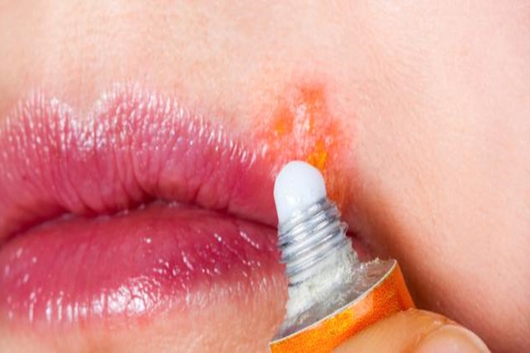 Roaccutane Uçuk Yapar Mı?