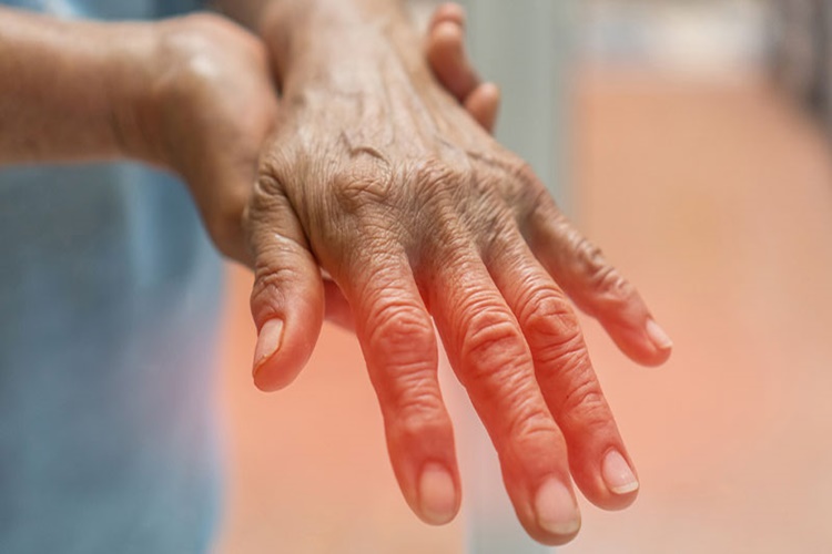 Romatoid Artrit Hastaları Malulen Emekli Olabilir Mı?