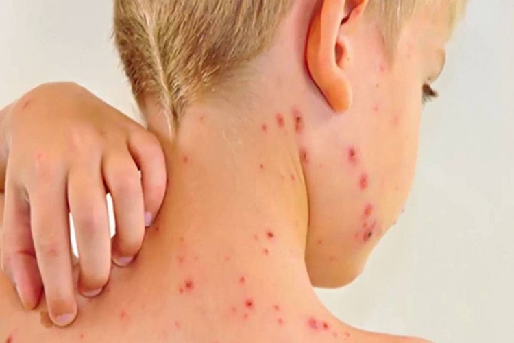 Rubella Testi Aç Karnına Mı Yapılır?
