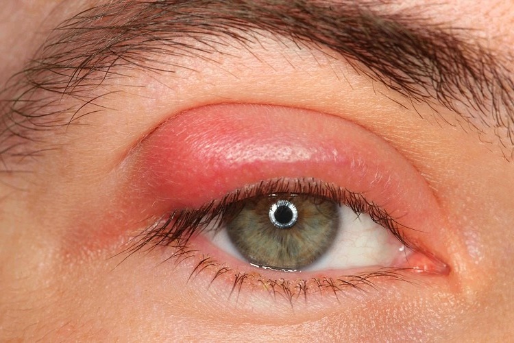 Rüyada Görülen Çıbandan Kan Aktığını Görmek Ne Anlama Gelir? - Güncel Oku