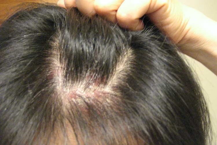 Saç Mantarı Tamamen Geçer Mi?