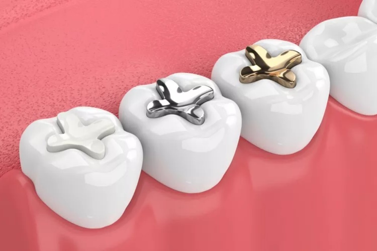 Sallanan Diş Dolgu Olur Mu?