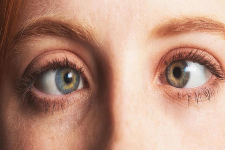 Şaşılık Ameliyatı Riskleri Nelerdir?