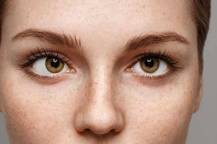 Şehla Gözün Tedavisi Var Mı?