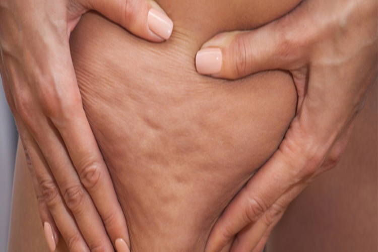 Selülit Bir Hastalık Mıdır?