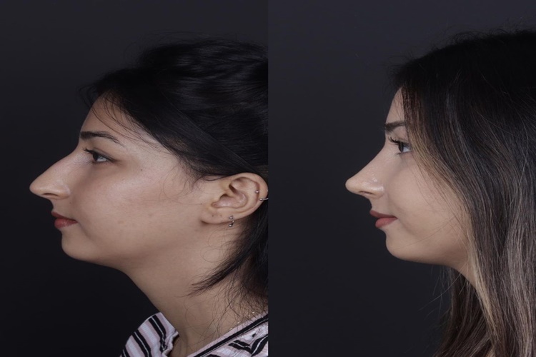 Septoplasti Devlet Karşılıyor Mu?