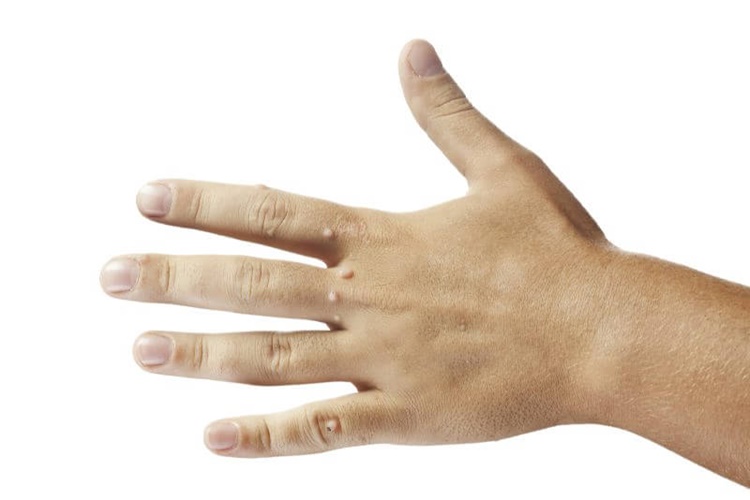 Siğil Polisliğe Engel Mi?