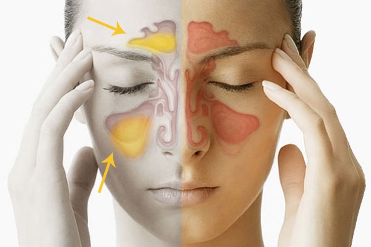 Sinüzit Polisliğe Engel Mi?