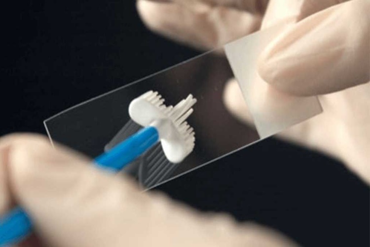 Smear Testi Kimlere Yapılmaz?