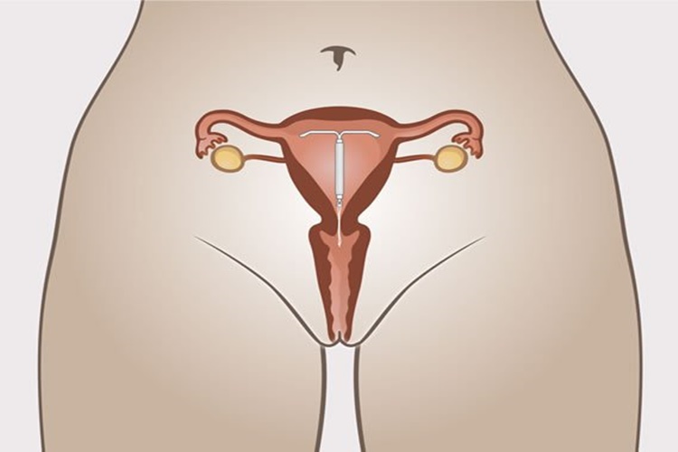 Spiral Varken Ara Kanama Neden Olur?