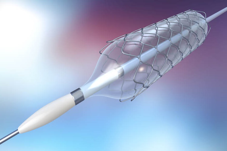 Stent Nereye Takılır?