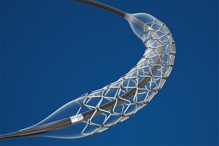 Stent Paslanır Mı?