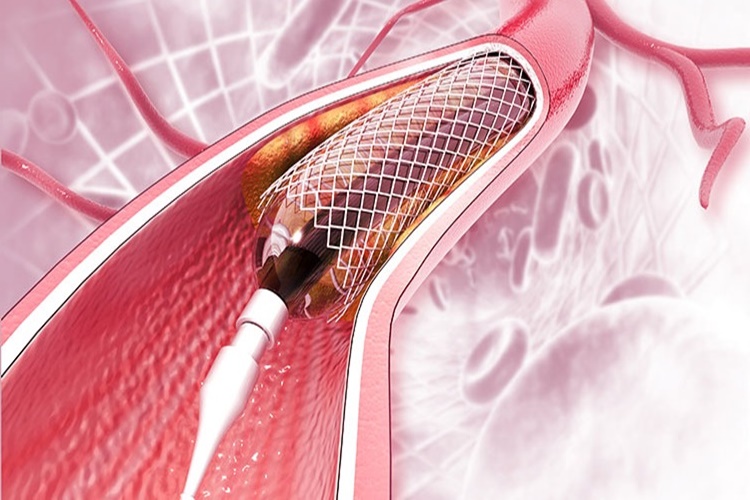 Stent Takılan Uçağa Binebilir Mi?