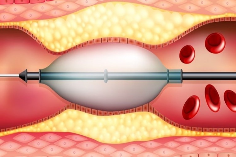 Stent Takıldıktan Sonra Çıkarılır Mı? - Güncel Oku