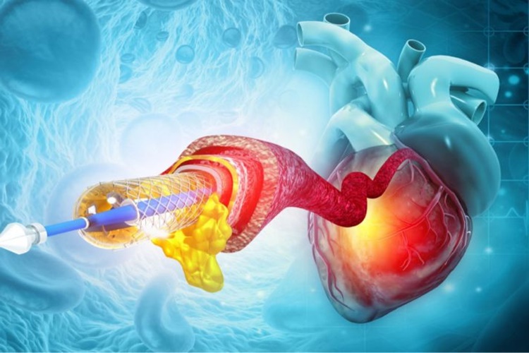 Stent Takıldıktan Sonra Denize Girilir Mi?