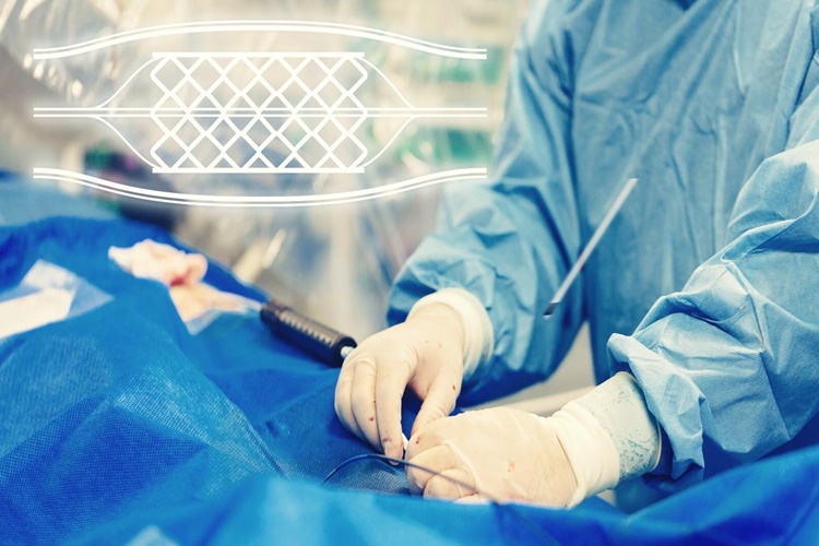 Stent Takıldıktan Sonra Hasta Neler Yaşar?
