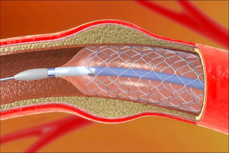 Stent Takıldıktan Sonra Nasıl Beslenmeli?