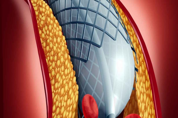 Stent Takıldıktan Sonra Sigara İçilir Mi?