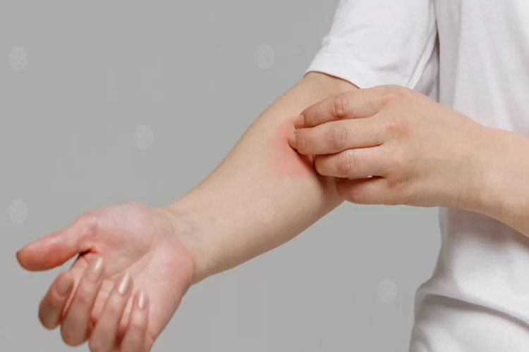 Stres Kaşıntı Yapar Mı?