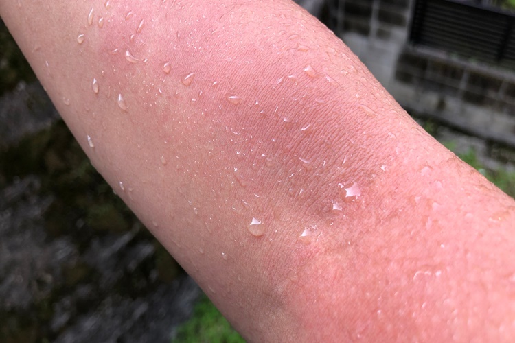 Suya Alerjik Olunur Mu? 
