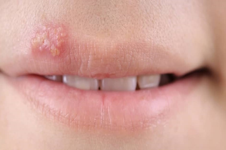 Terramycin Uçuğa İyi Gelir Mi?
