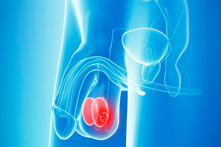 Testis Kanseri Tedavisi Nasıl Olur?