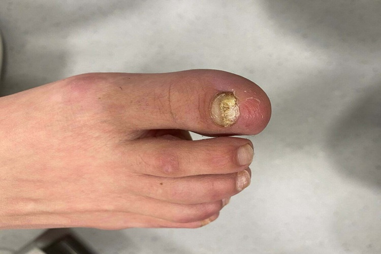 Tırnak Mantarı İçin Hangi Doktora Gidilir?