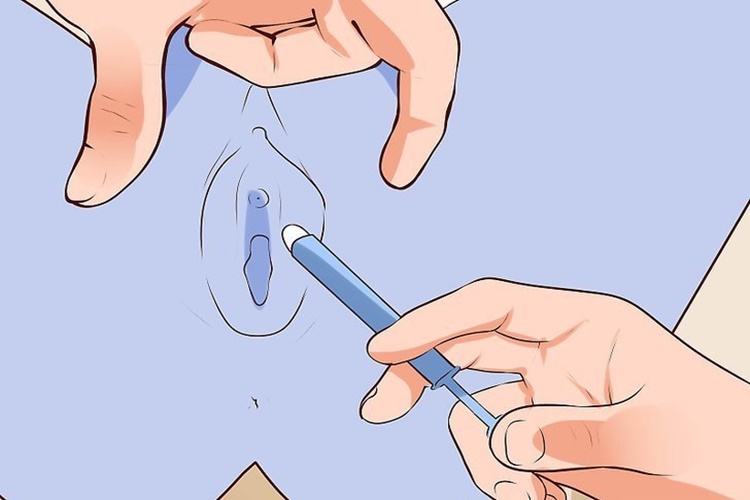 Trivag Ovül Kaşıntı Yapar Mı?