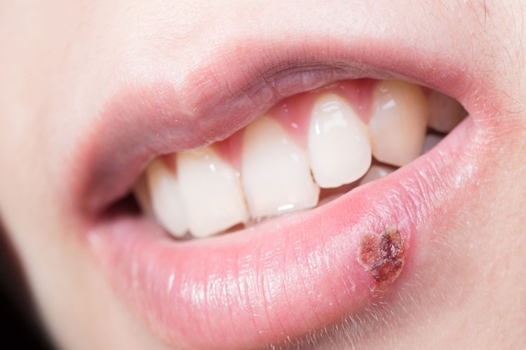 Uçuk Bebeğe Zarar Verir Mi?