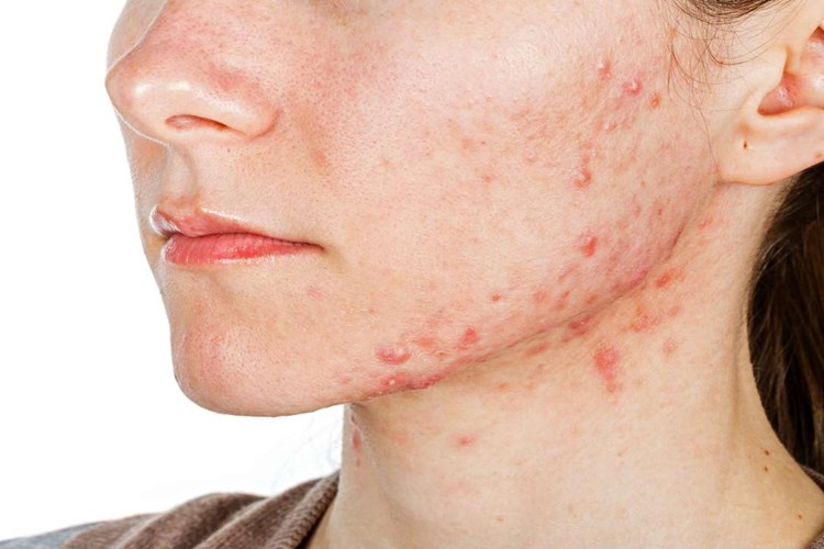 Ürederm Lipo Sivilce Yapar Mı?