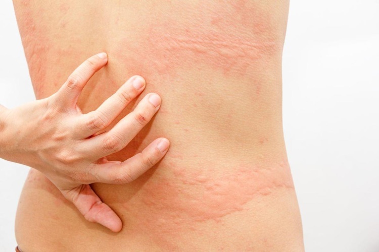 Ürtiker Hangi Vitamin Eksikliğinden Olur?