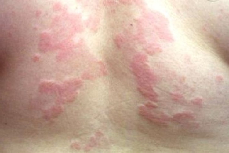 Ürtiker Kalıcı Mı?