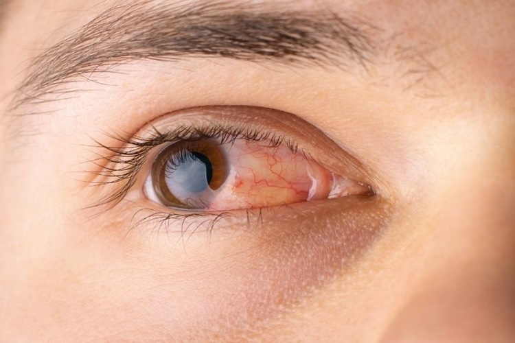 Üveit Polisliğe Engel Mi?