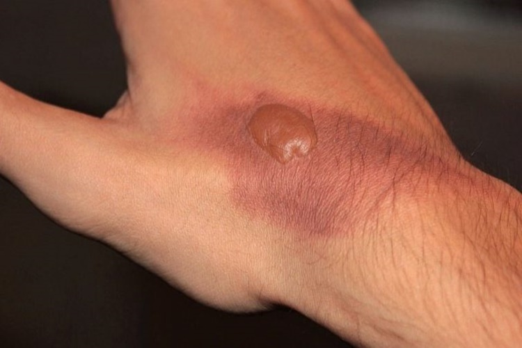 Vicks Yanığa İyi Gelir Mi?