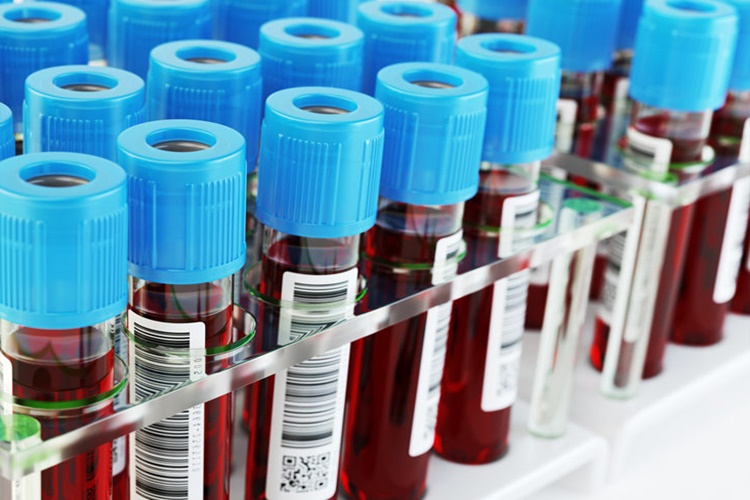 Vitamin Değerleri Testi Aç Karnına Mı Yapılır?