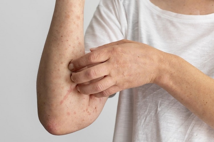 Vitamin Eksikliği Alerji Yapar Mı?