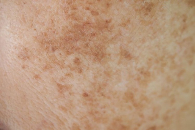 Vitamin Eksikliği Cilt Lekesi Yapar Mı?