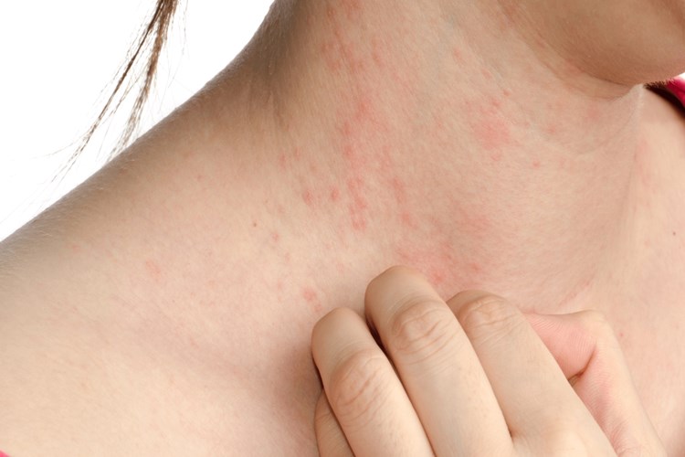 Vitamin Eksikliği Deri Döküntüsü Yapar Mı?