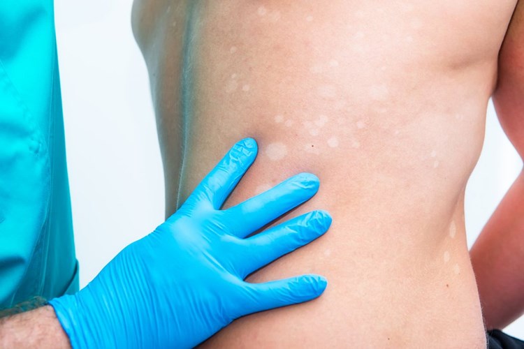 Vitamin Fazlalığı Cilt Lekesi Yapar Mı?