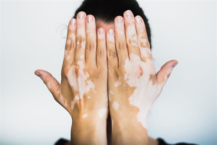 Vitiligo Anneden Bebeğe Geçer Mi?