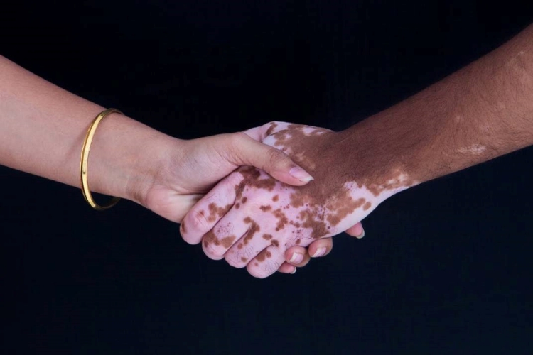 Vitiligo Genetik Midir?